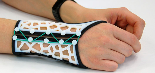 Loughborough University lecturer developed software for clinicians to design and make custom-made 3D printed wrist splints for rheumatoid arthritis sufferers