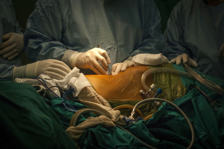 The first cut of a kidney transplant operation ©BELGA_EYEVINE_C.Stennett