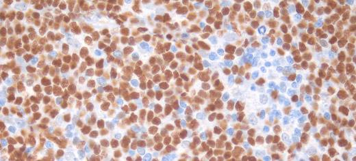 University of Leeds database helps match patients with certain types of blood cancers to the best treatments