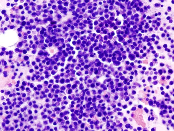 Research shows the possibility to prevent incurable type of blood cancer from developing with early medical intervention
